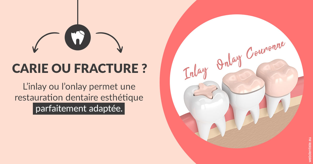 https://dentistes-trinite.com/T2 2023 - Carie ou fracture 2