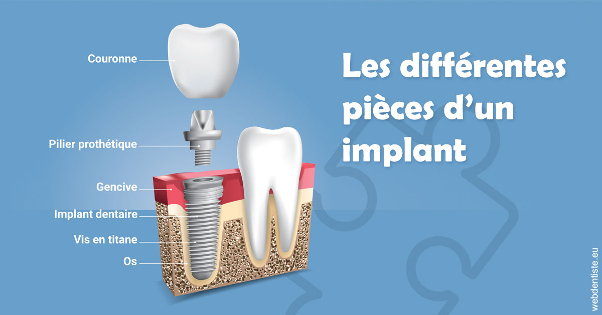 https://dentistes-trinite.com/Les différentes pièces d’un implant 1